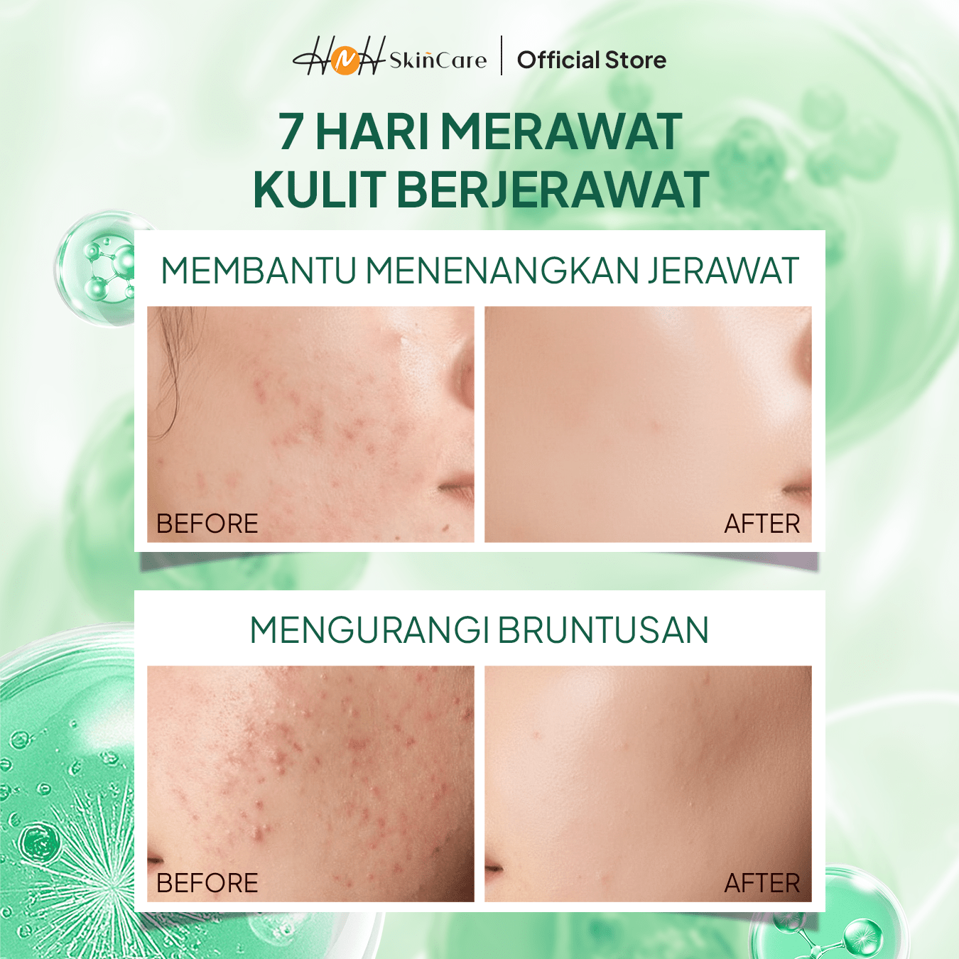HNH Skincare - Acne Glow Serum - Serum Jerawat dan Bruntusan untuk Merawat Kulit Acne - Prone - hnhskincare