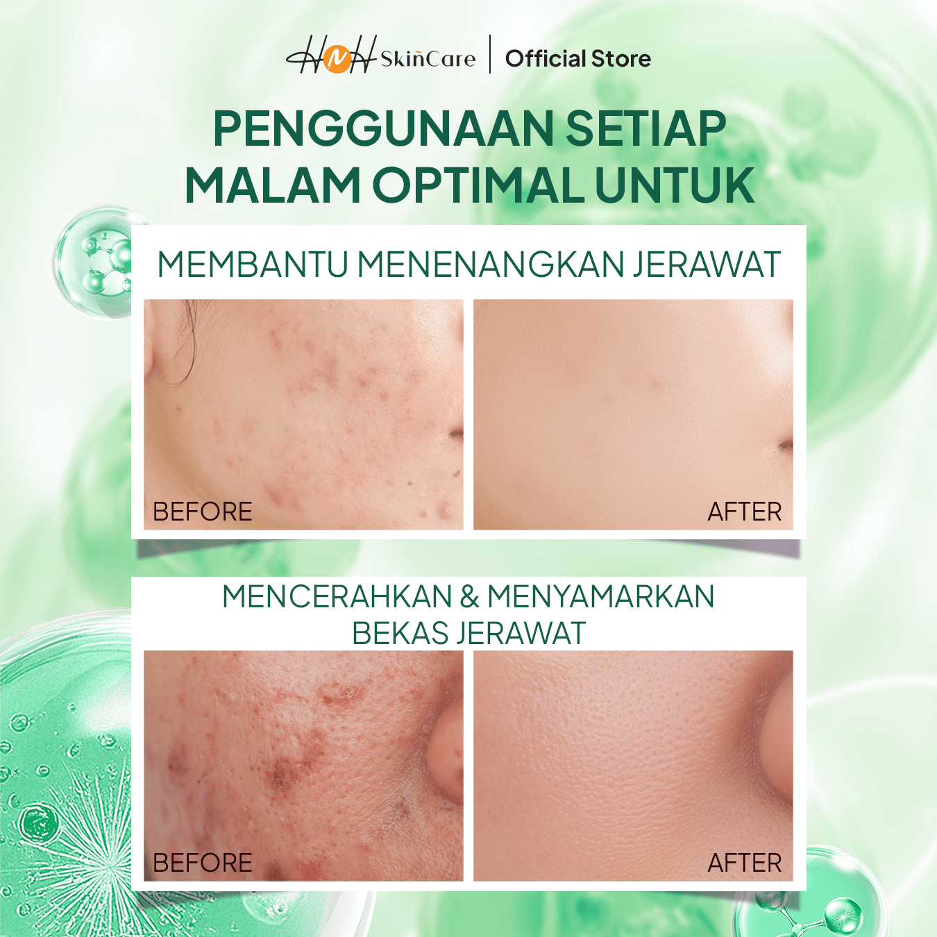 HNH Skincare - Azeloyl Night Cream - Krim Malam Jerawat dan Bekas Jerawat dengan Tekstur Ringan - hnhskincare