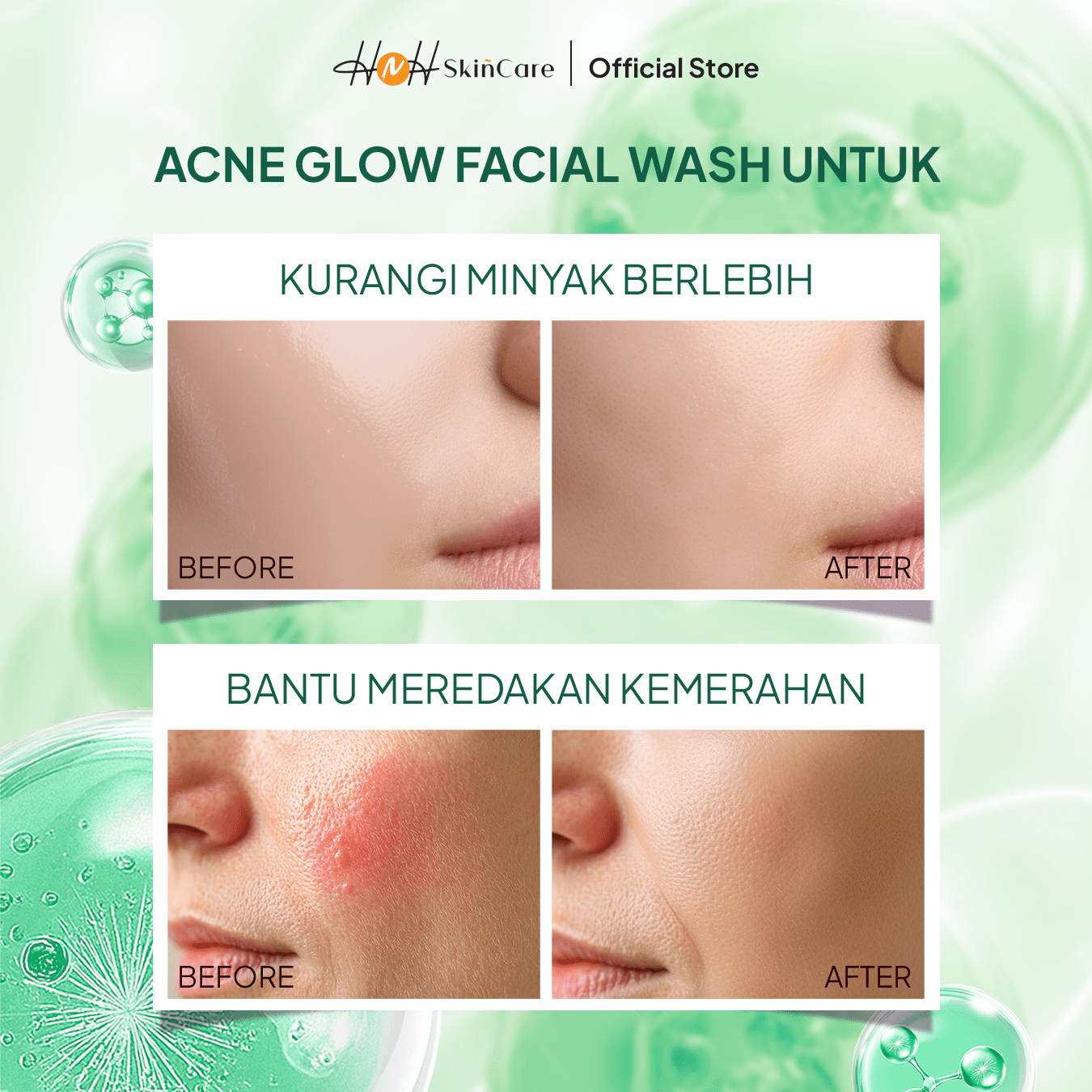 HNH Skincare - Bundling 2 Facial Wash Acne Glow - Sabun Cuci Muka Gentle untuk Kulit Berminyak & Berjerawat - hnhskincare