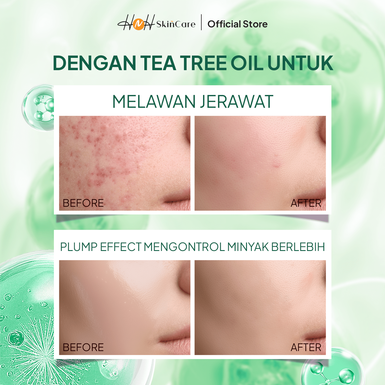 HNH Skincare - Sunscreen Acne Glow - Sunscreen Wajah SPF 30 PA+++ untuk Kulit Berminyak, Berjerawat - hnhskincare